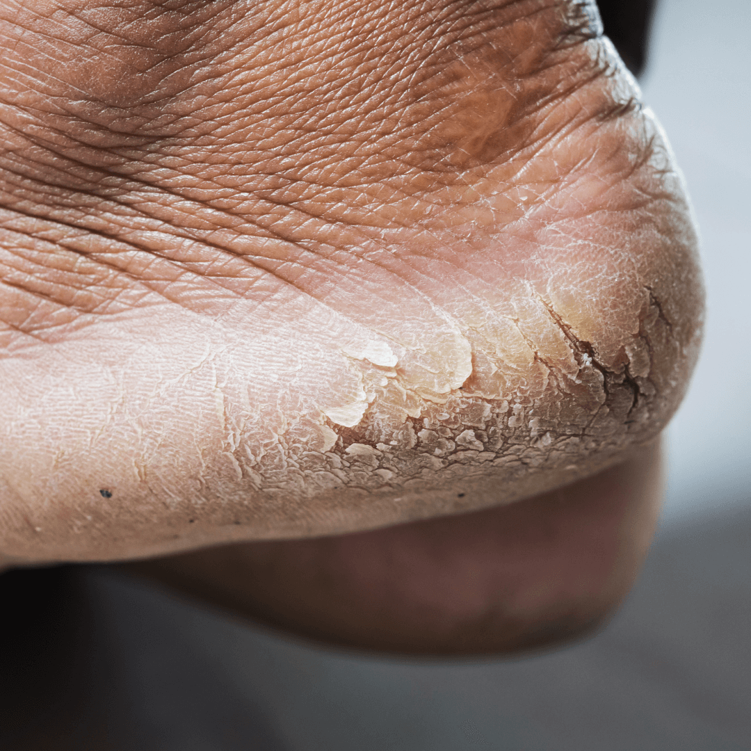 How to Get Rid of Hard Skin on Dry Feet Avanza Skin