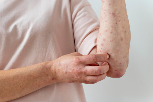 Is Excessive Sweating or Eczema Keeping You from Exercising?