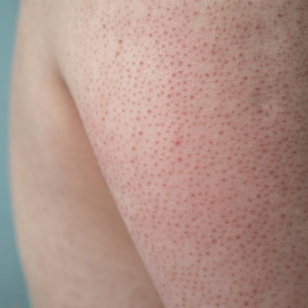 understanding-keratosis-pilaris-causes-and-treatments